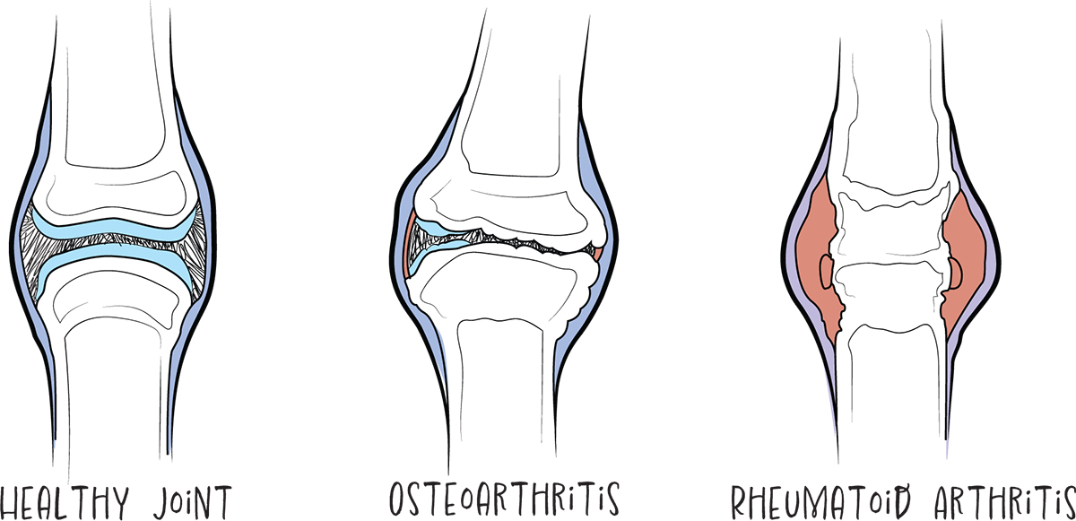 sketch drawing of a healthy joint, osteoarthritis, rheumatoid arthritis