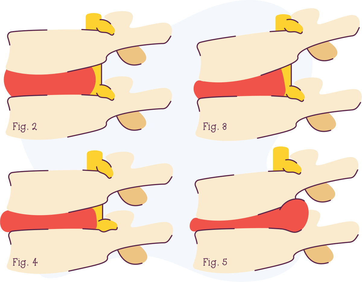 digital illustration of spinal cushion